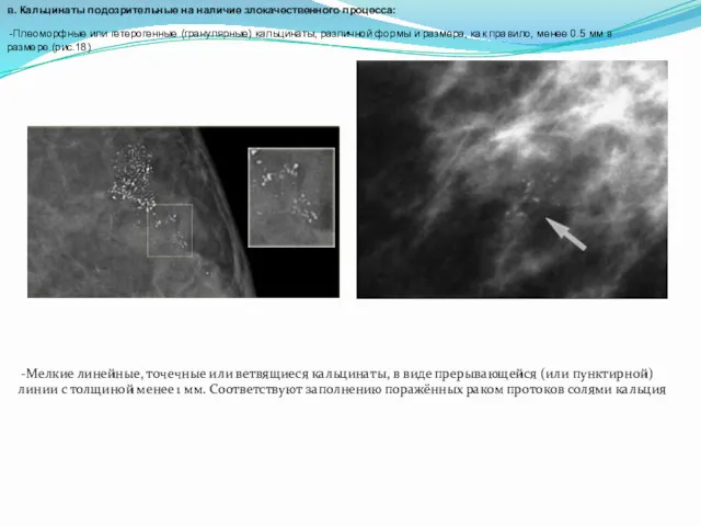 в. Кальцинаты подозрительные на наличие злокачественного процесса: -Плеоморфные или гетерогенные