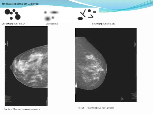 -Описание формы кальцинатов: Мономорфные(рис.24) Аморфные Полиморфные(рис.25) Рис.24 - Мономорфные кальцинаты. Рис.25 – Полиморфные кальцинаты.