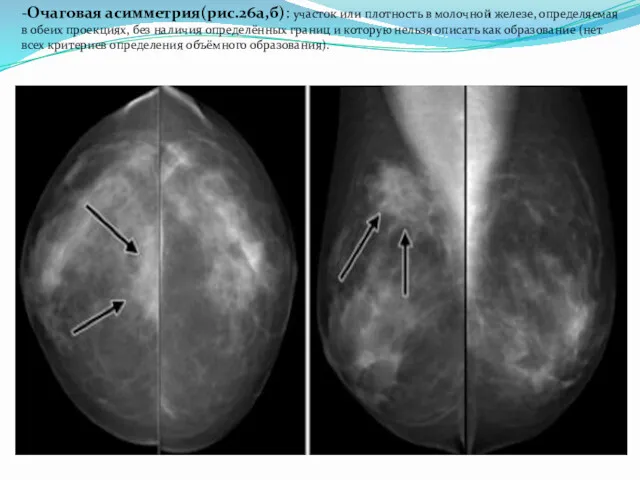 -Очаговая асимметрия(рис.26а,б): участок или плотность в молочной железе, определяемая в