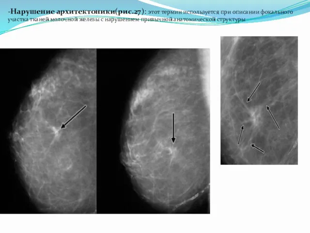 -Нарушение архитектоники(рис.27): этот термин используется при описании фокального участка тканей