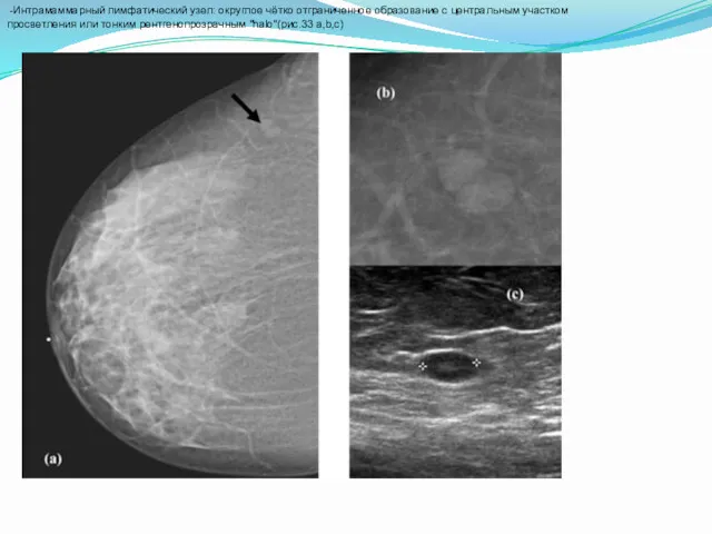 -Интрамаммарный лимфатический узел: округлое чётко отграниченное образование с центральным участком просветления или тонким рентгенопрозрачным "halo"(рис.33 a,b,c)