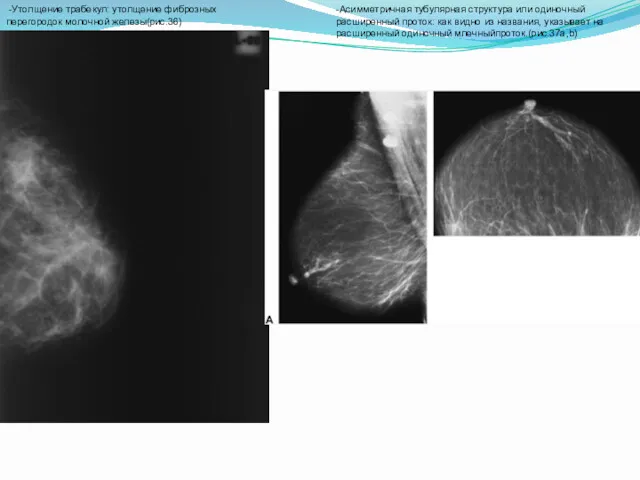 -Утолщение трабекул: утолщение фиброзных перегородок молочной железы(рис.36) -Асимметричная тубулярная структура