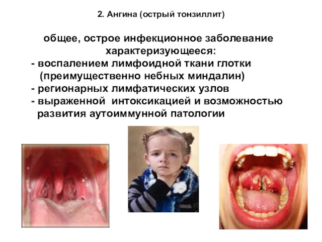 2. Ангина (острый тонзиллит) общее, острое инфекционное заболевание характеризующееся: -