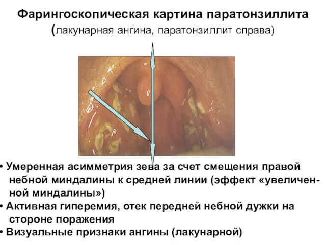 Фарингоскопическая картина паратонзиллита (лакунарная ангина, паратонзиллит справа) Умеренная асимметрия зева