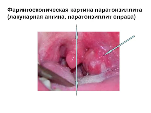 Фарингоскопическая картина паратонзиллита (лакунарная ангина, паратонзиллит справа)