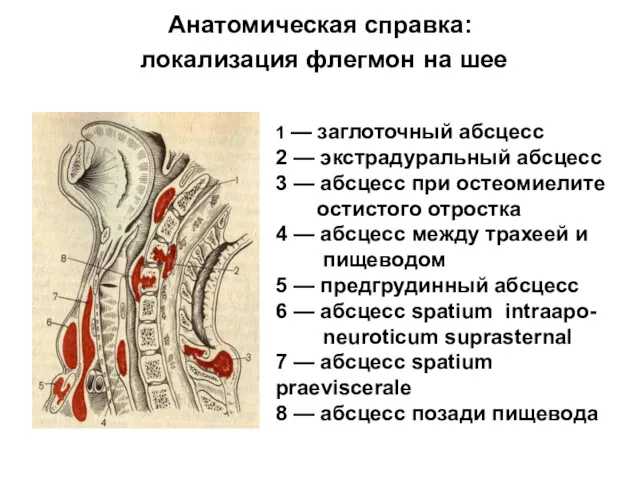 Анатомическая справка: локализация флегмон на шее 1 — заглоточный абсцесс