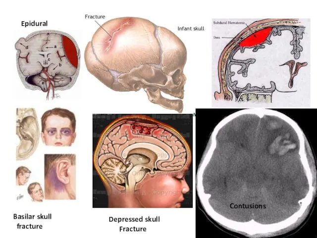 Epidural Basilar skull fracture Depressed skull Fracture Contusions