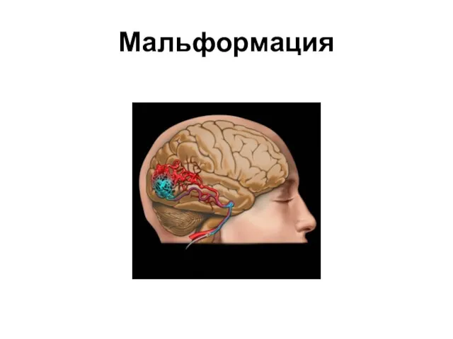 Мальформация