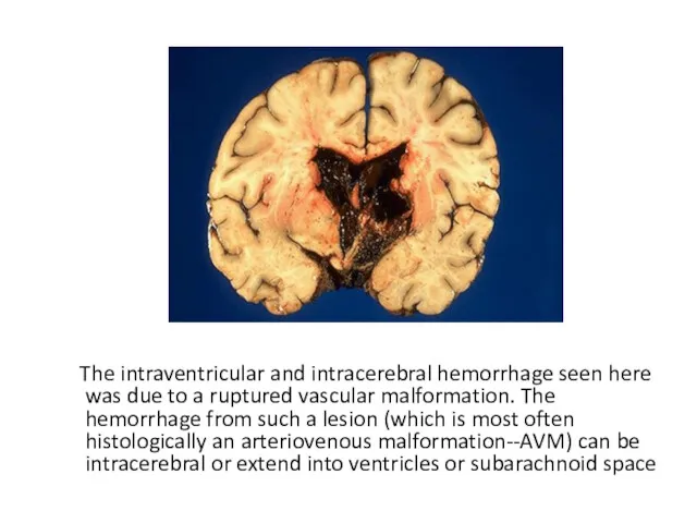 The intraventricular and intracerebral hemorrhage seen here was due to