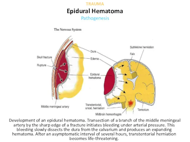 Development of an epidural hematoma. Transection of a branch of