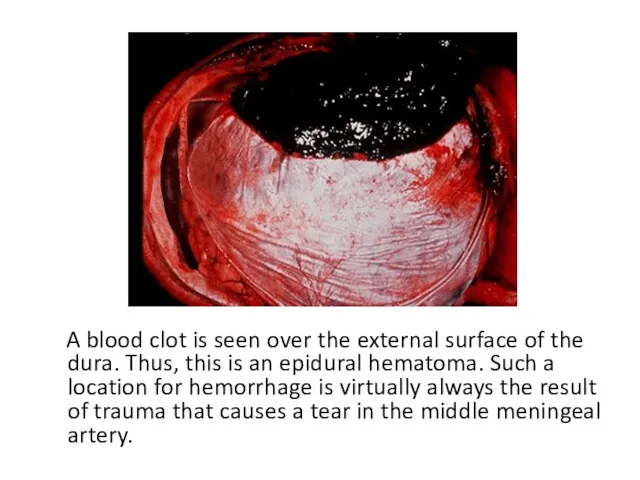 A blood clot is seen over the external surface of