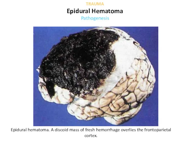 Epidural hematoma. A discoid mass of fresh hemorrhage overlies the frontoparietal cortex. TRAUMA Epidural Hematoma Pathogenesis