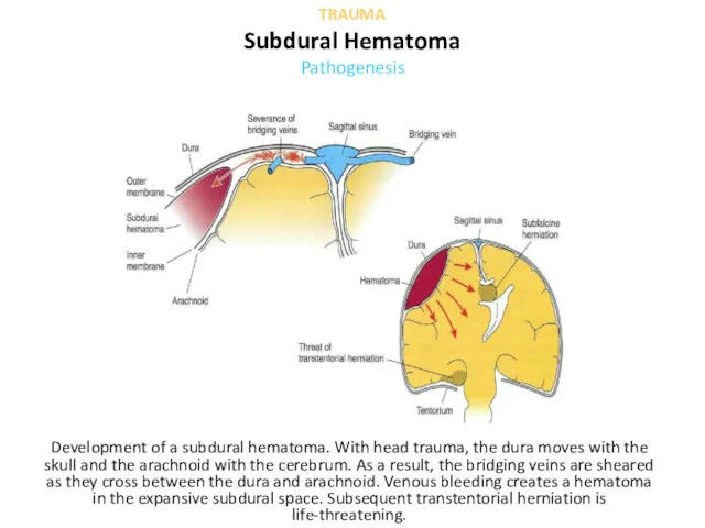 Development of a subdural hematoma. With head trauma, the dura