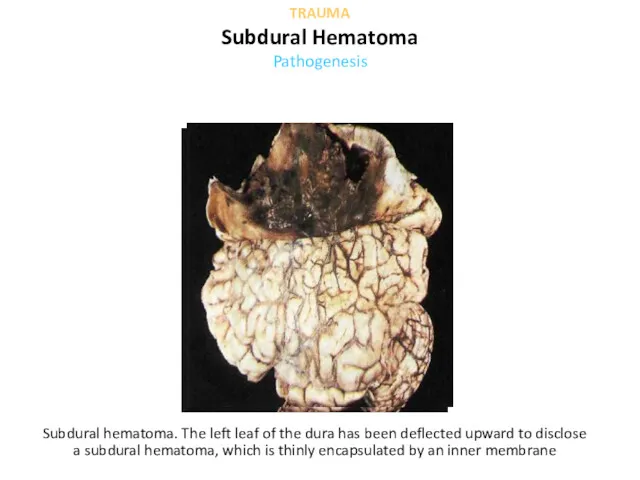 Subdural hematoma. The left leaf of the dura has been