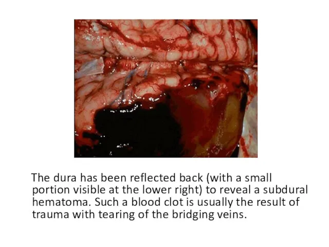 The dura has been reflected back (with a small portion