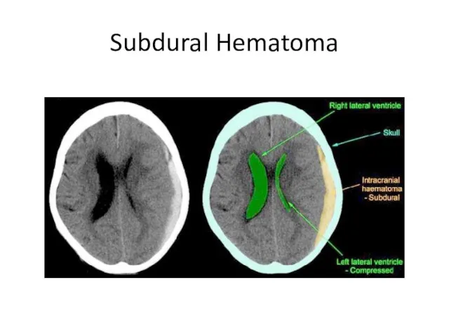 Subdural Hematoma