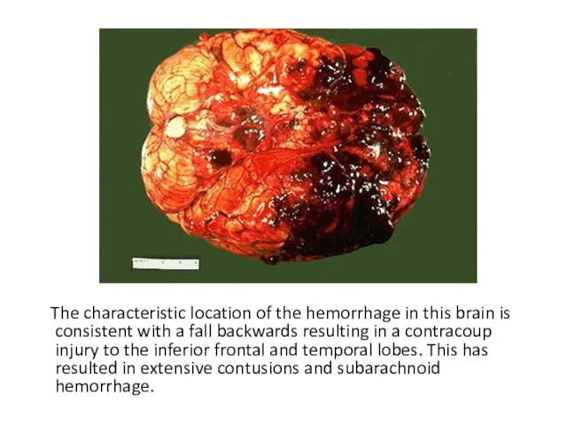 The characteristic location of the hemorrhage in this brain is