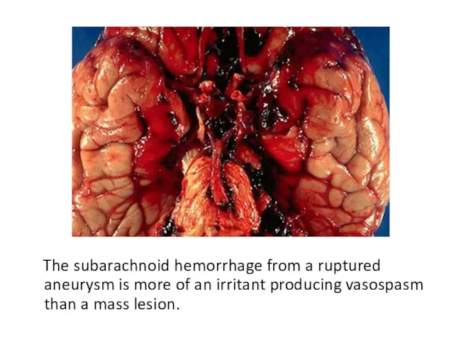 The subarachnoid hemorrhage from a ruptured aneurysm is more of