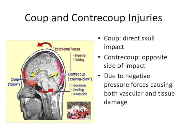 Coup and Contrecoup Injuries Coup: direct skull impact Contrecoup: opposite