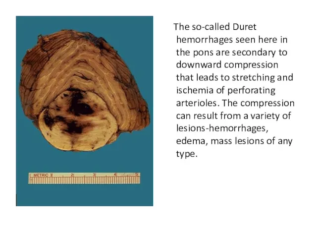 The so-called Duret hemorrhages seen here in the pons are