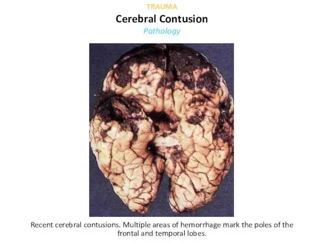 Recent cerebral contusions. Multiple areas of hemorrhage mark the poles