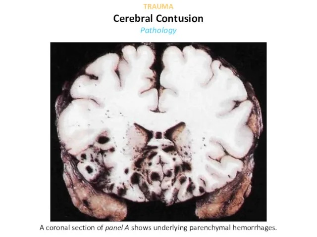 A coronal section of panel A shows underlying parenchymal hemorrhages. TRAUMA Cerebral Contusion Pathology