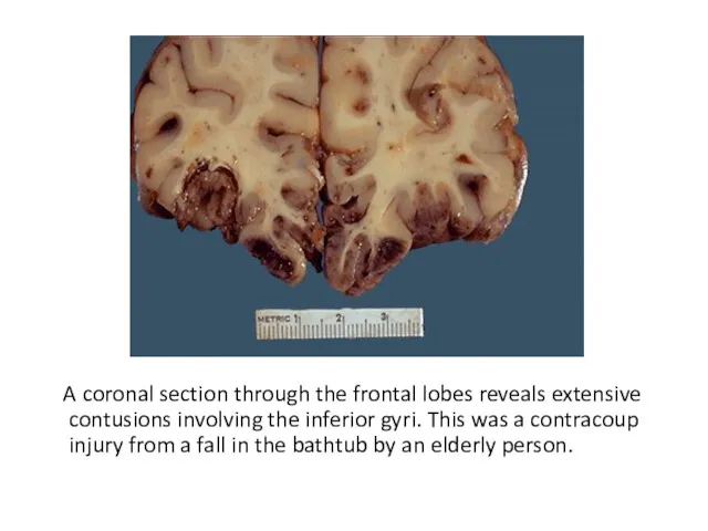 A coronal section through the frontal lobes reveals extensive contusions