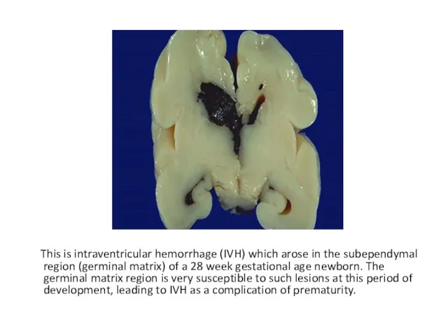 This is intraventricular hemorrhage (IVH) which arose in the subependymal