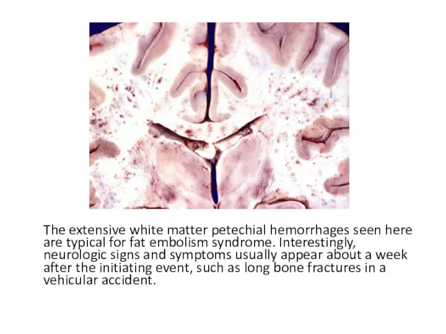 The extensive white matter petechial hemorrhages seen here are typical