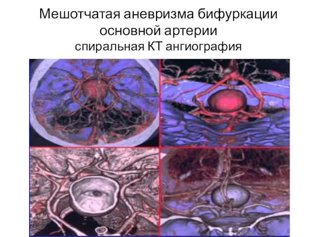 Мешотчатая аневризма бифуркации основной артерии спиральная КТ ангиография