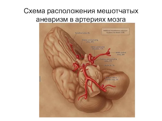 Схема расположения мешотчатых аневризм в артериях мозга