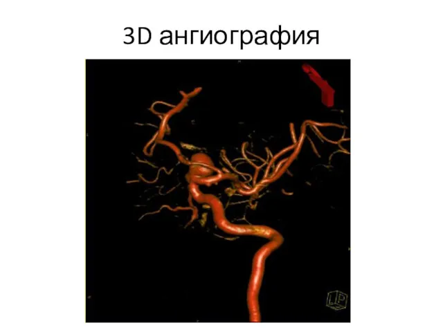 3D ангиография