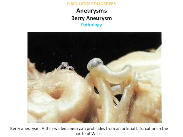 Berry aneurysm. A thin-walled aneurysm protrudes from an arterial bifurcation