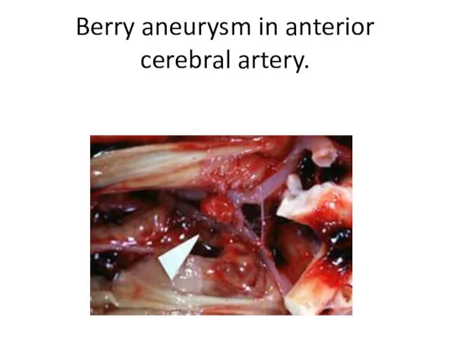 Berry aneurysm in anterior cerebral artery.