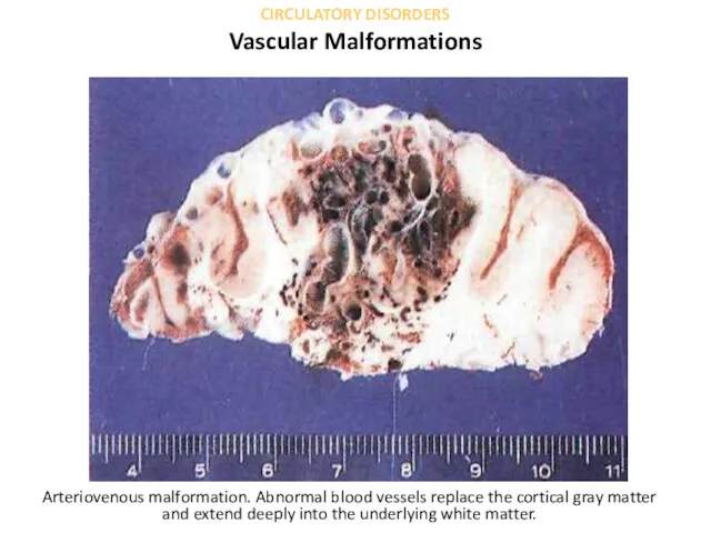 Arteriovenous malformation. Abnormal blood vessels replace the cortical gray matter