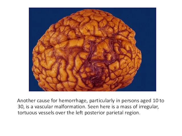 Another cause for hemorrhage, particularly in persons aged 10 to