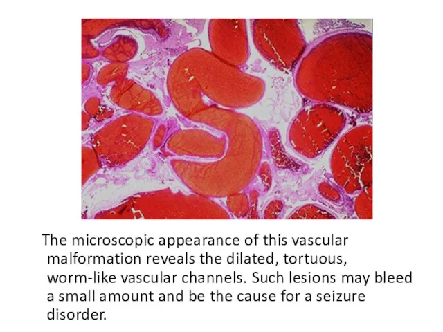 The microscopic appearance of this vascular malformation reveals the dilated,