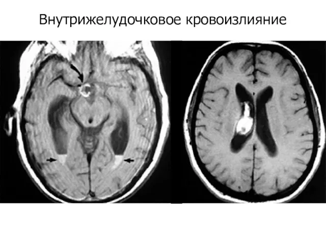 Внутрижелудочковое кровоизлияние