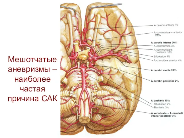 Мешотчатые аневризмы – наиболее частая причина САК