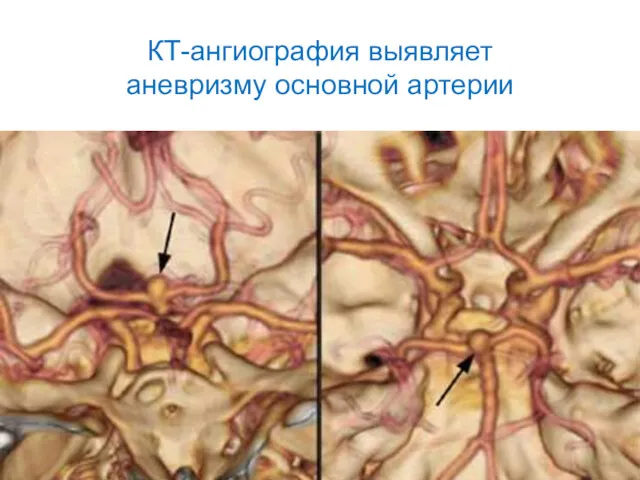 КТ-ангиография выявляет аневризму основной артерии