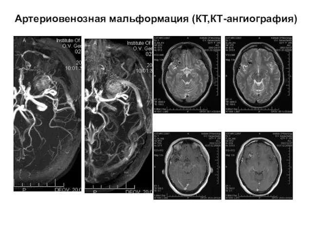 Артериовенозная мальформация (КТ,КТ-ангиография)