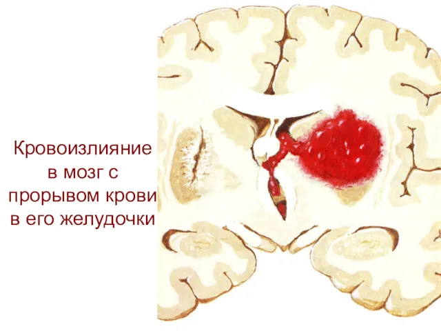 Кровоизлияние в мозг с прорывом крови в его желудочки
