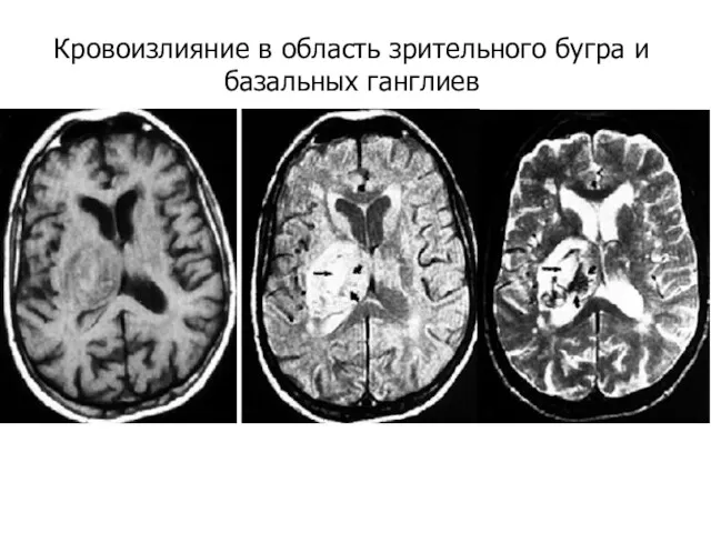 Кровоизлияние в область зрительного бугра и базальных ганглиев