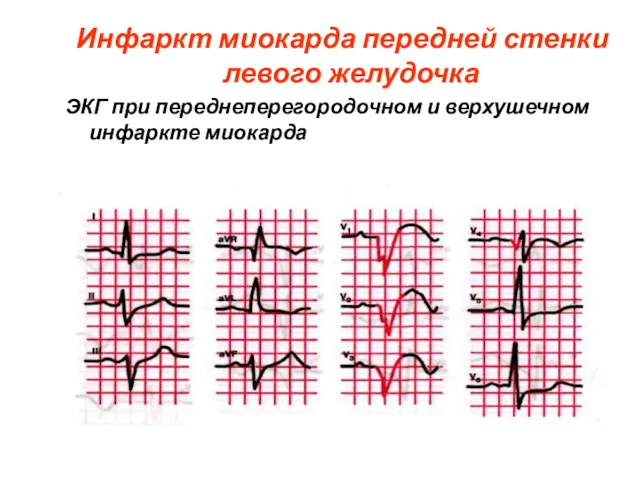 Инфаркт миокарда передней стенки левого желудочка ЭКГ при переднеперегородочном и верхушечном инфаркте миокарда
