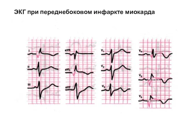 ЭКГ при переднебоковом инфаркте миокарда