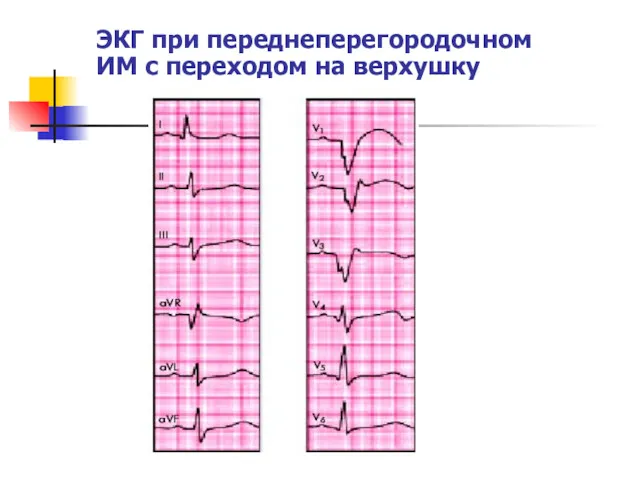 ЭКГ при переднеперегородочном ИМ с переходом на верхушку