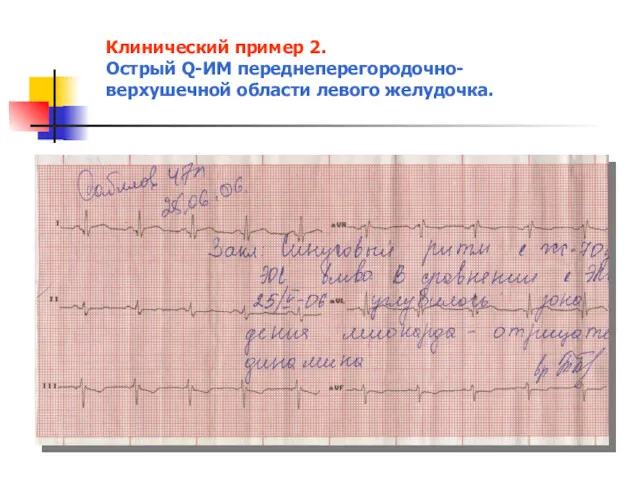 Клинический пример 2. Острый Q-ИМ переднеперегородочно-верхушечной области левого желудочка.