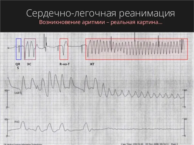 Сердечно-легочная реанимация Возникновение аритмии – реальная картина… QRS ЭС R-на-T ЖТ
