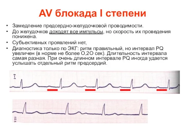AV блокада I степени Замедление предсердно-желудочковой проводимости. До желудочков доходят все импульсы, но