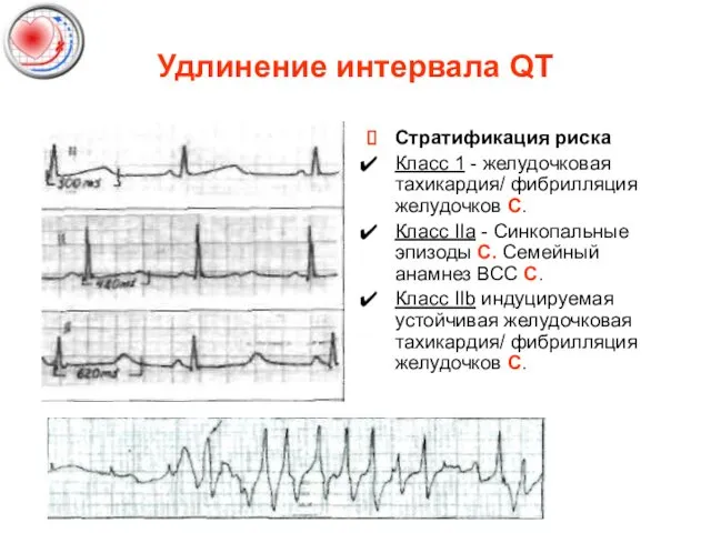 Удлинение интервала QT Стратификация риска Класс 1 - желудочковая тахикардия/ фибрилляция желудочков С.